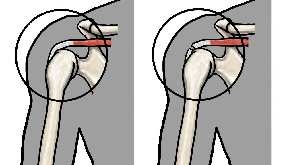 スポーツの肩の痛み│腱板炎・インピンジメント症候群