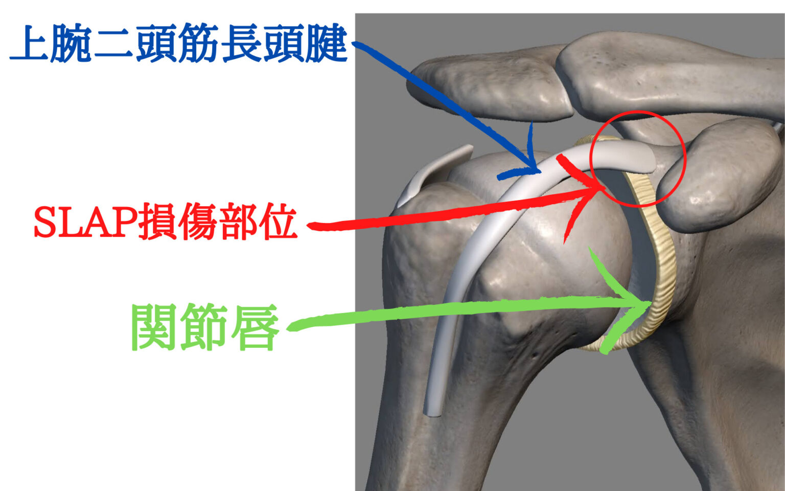 肩の痛みは腱炎である可能性があります。治療方法を見る